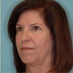 Facelift Before & After Patient #235