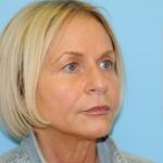 Facelift Before & After Patient #242