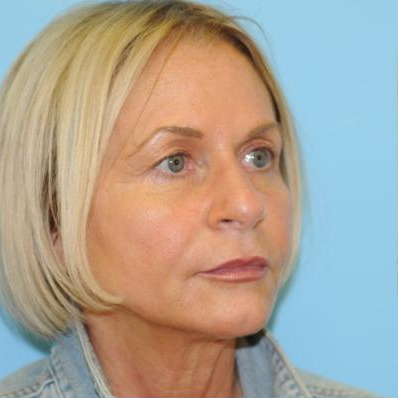 Facelift Before & After Patient #242
