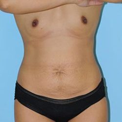 Abdominoplasty Before & After Patient #66