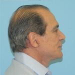 Facelift Before & After Patient #249