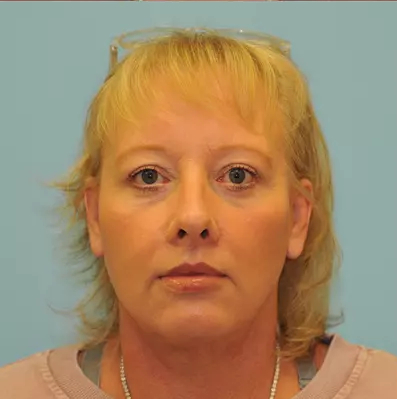 Facelift Before & After Patient #256