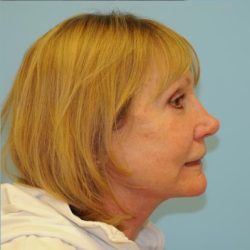 Facelift Before & After Patient #263