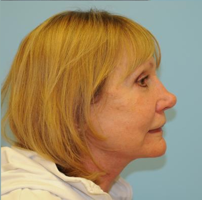 Facelift Before & After Patient #263