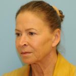 Facelift Before & After Patient #2766