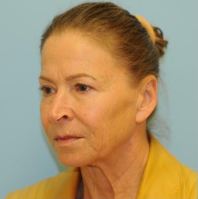 Facelift Before & After Patient #270