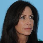 Facelift Before & After Patient #277
