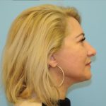 Facelift Before & After Patient #284