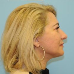 Facelift Before & After Patient #284