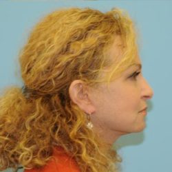 Facelift Before & After Patient #291
