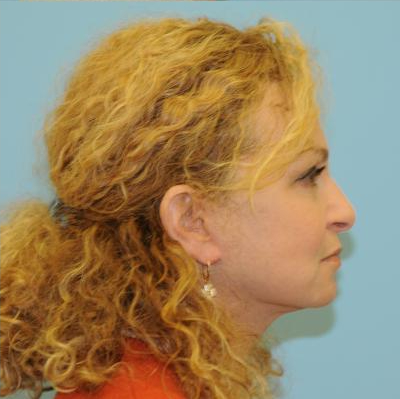 Facelift Before & After Patient #291