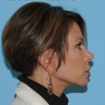Facelift Before & After Patient #298