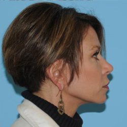 Facelift Before & After Patient #298