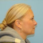 Blepharoplasty Before & After Patient #305