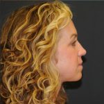 Blepharoplasty Before & After Patient #312