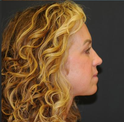 Blepharoplasty Before & After Patient #312