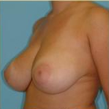 Breast Reduction Before & After Patient #333