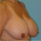 Breast Reduction Before & After Patient #340