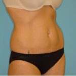 Abdominoplasty Before & After Patient #94