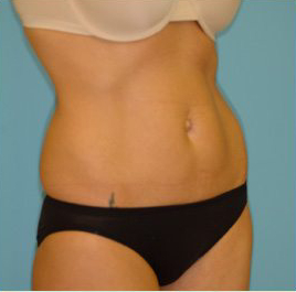 Abdominoplasty Before & After Patient #94