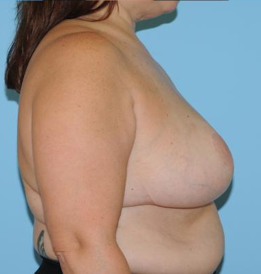 Breast Reduction Before & After Patient #382