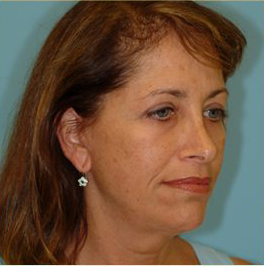 Facelift Before & After Patient #396