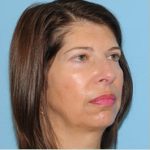 Facelift Before & After Patient #410