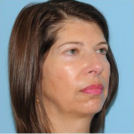 Facelift Before & After Patient #410