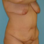 Abdominoplasty Before & After Patient #101