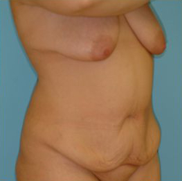 Abdominoplasty Before & After Patient #101