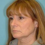 Facelift Before & After Patient #417