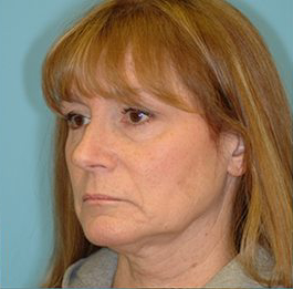 Facelift Before & After Patient #417