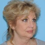 Facelift Before & After Patient #424