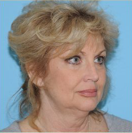 Facelift Before & After Patient #424
