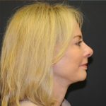 Facelift Before & After Patient #445