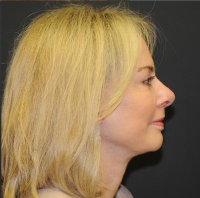 Facelift Before & After Patient #445