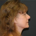 Facelift Before & After Patient #452