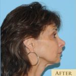 Fat Grafting Before & After Patient #459