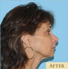 Fat Grafting Before & After Patient #459