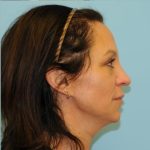 Fat Grafting Before & After Patient #466
