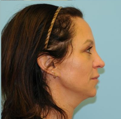 Fat Grafting Before & After Patient #466
