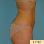 Liposuction Before & After Patient #473