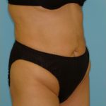 Abdominoplasty Before & After Patient #108