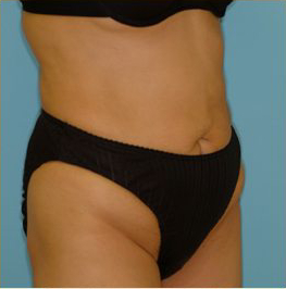 Abdominoplasty Before & After Patient #108