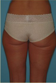 Liposuction Before & After Patient #487
