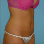 Liposuction Before & After Patient #492