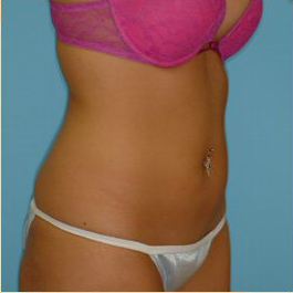 Liposuction Before & After Patient #492