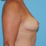 Explanation with Mastopexy Before & After Patient #513