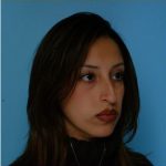 Rhinoplasty Before & After Patient #534