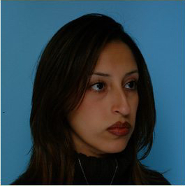 Rhinoplasty Before & After Patient #534